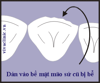 Ultrathin Veneer Kỹ thuật làm VENEER sứ siêu mỏng