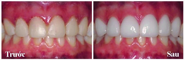 Răng bị xỉn màu và có miếng trám cũ đổi màu