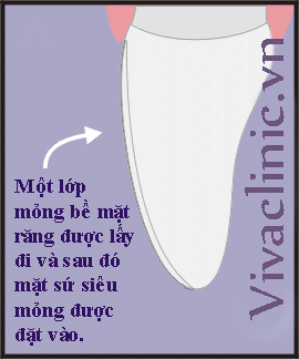 Ultrathin Veneer Kỹ thuật làm VENEER sứ siêu mỏng