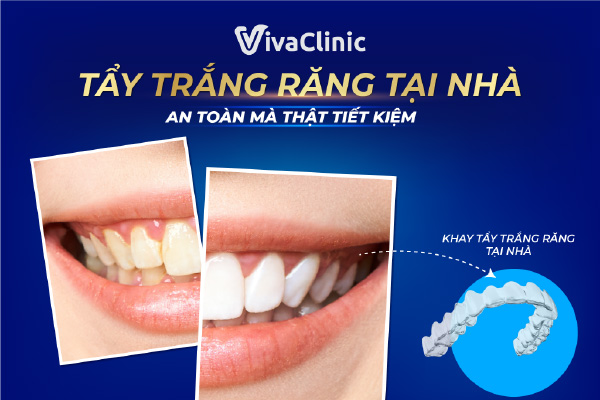 tẩy trắng răng tại nhà