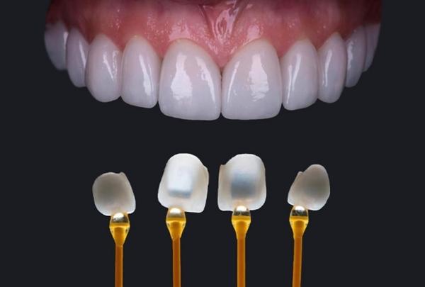 Ưu điểm nổi bật của dán răng sứ veneer emax