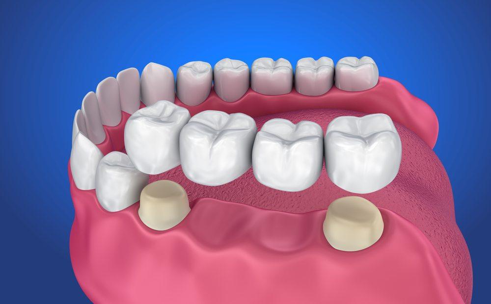 Đâu là sự khác nhau giữa răng sứ bắc cầu và Implant