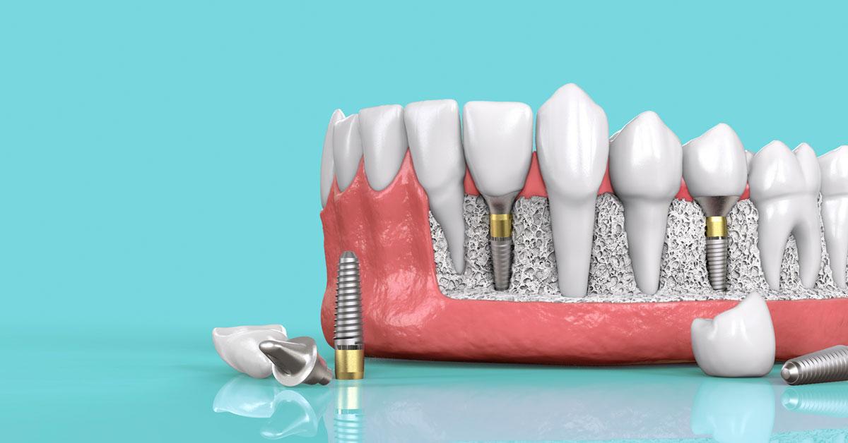 Độ bền của 2 phương pháp này khác nhau dựa vào nhiều yếu tố Phân biệt răng sứ bắc cầu và implant