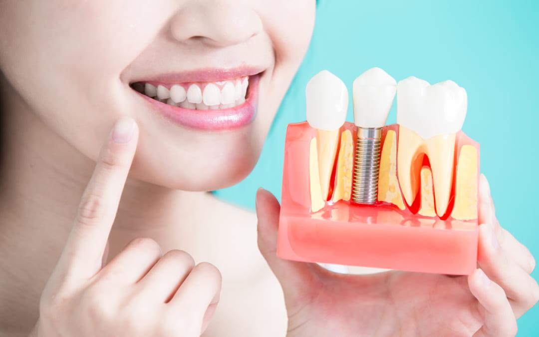 Phân biệt răng sứ bắc cầu và Implant