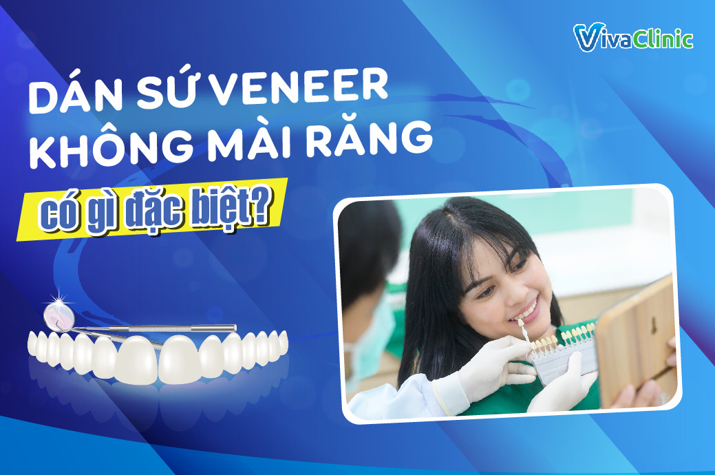 Khám phá dán sứ veneer emax và những ưu điểm tuyệt vời