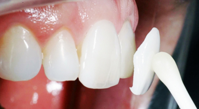Chi tiết về nhược điểm của dán răng sứ