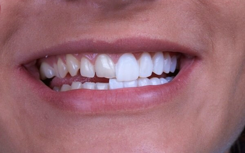 Nhược điểm của dán răng sứ thường gặp