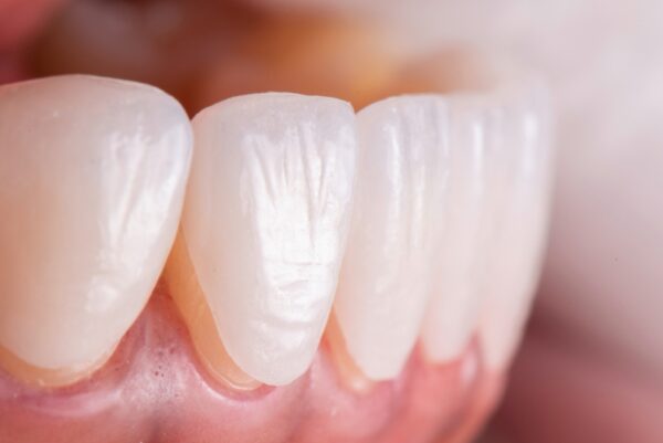 Dán răng sứ đòi hỏi chuyên môn cao của bác sĩ