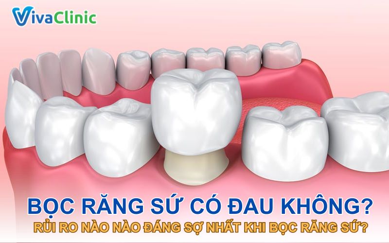 Các loại bọc răng sứ phổ biến