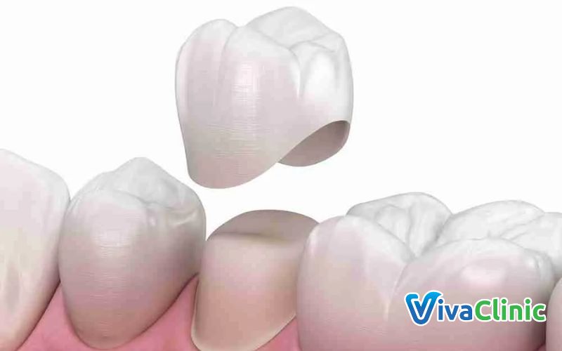 Lựa chọn phương pháp bọc răng sứ phù hợp