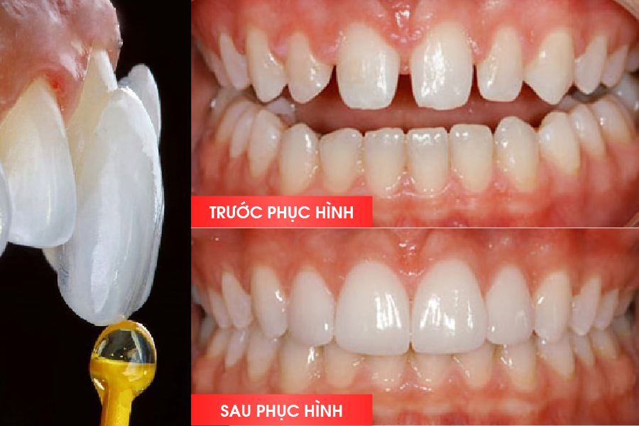 Trường hợp áp dụng phương pháp bọc răng sứ không mài