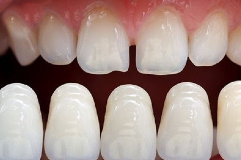 ưu và nhược điểm của phương pháp bọc răng sứ không mài