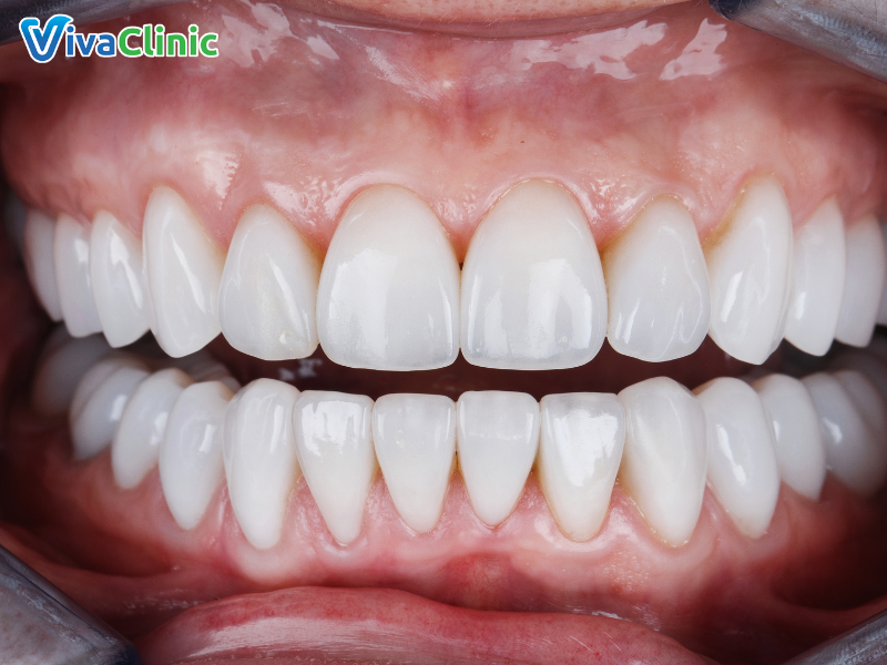Chi tiết về quy trình bọc răng sứ chuẩn y khoa