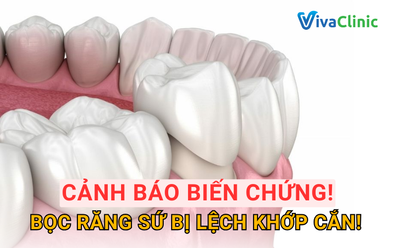 Tại sao khi bọc răng sứ bị lệch khớp cắn - Nguyên nhân tiềm ẩn