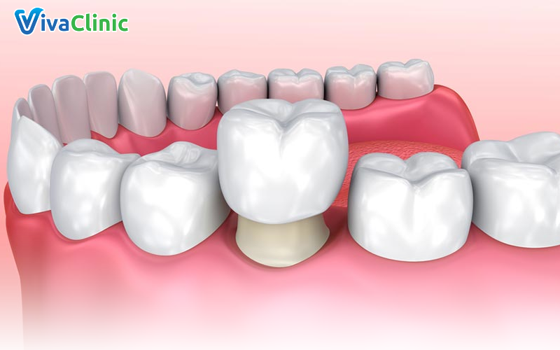 Tại sao khi bọc răng sứ bị lệch khớp cắn - Nguyên nhân tiềm ẩn