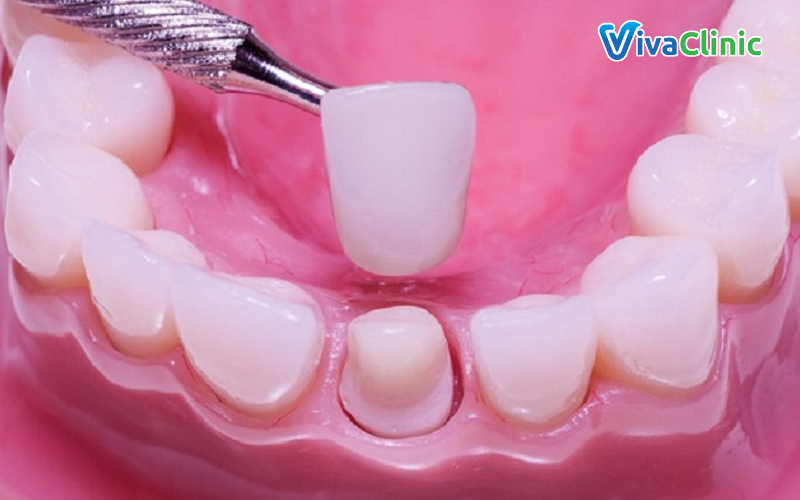 Giải pháp để tránh bọc răng sứ bị lệch khớp cắn