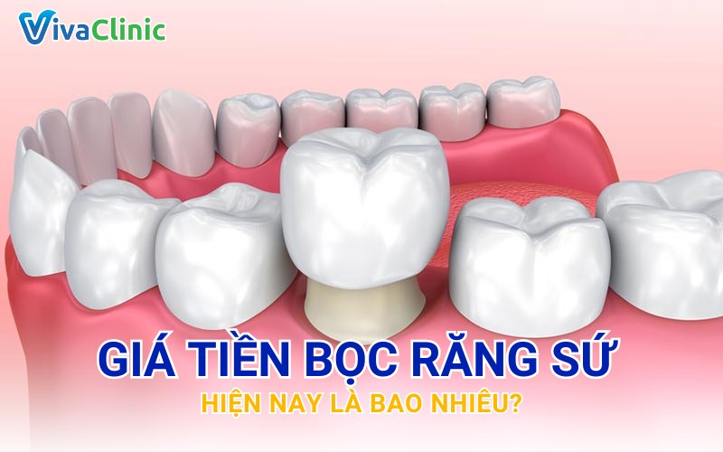 Bảng giá bọc răng sứ tại Nha Khoa Viva Clinic