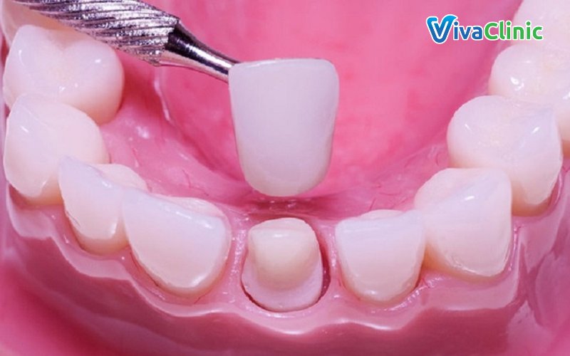 Một số loại bọc răng sứ hiện nay