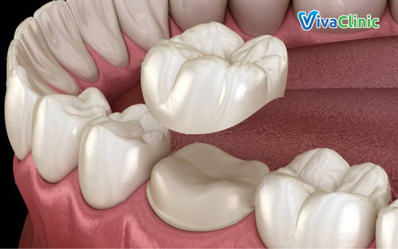 Lý do nên bọc răng sứ tại nha khoa khác nhau