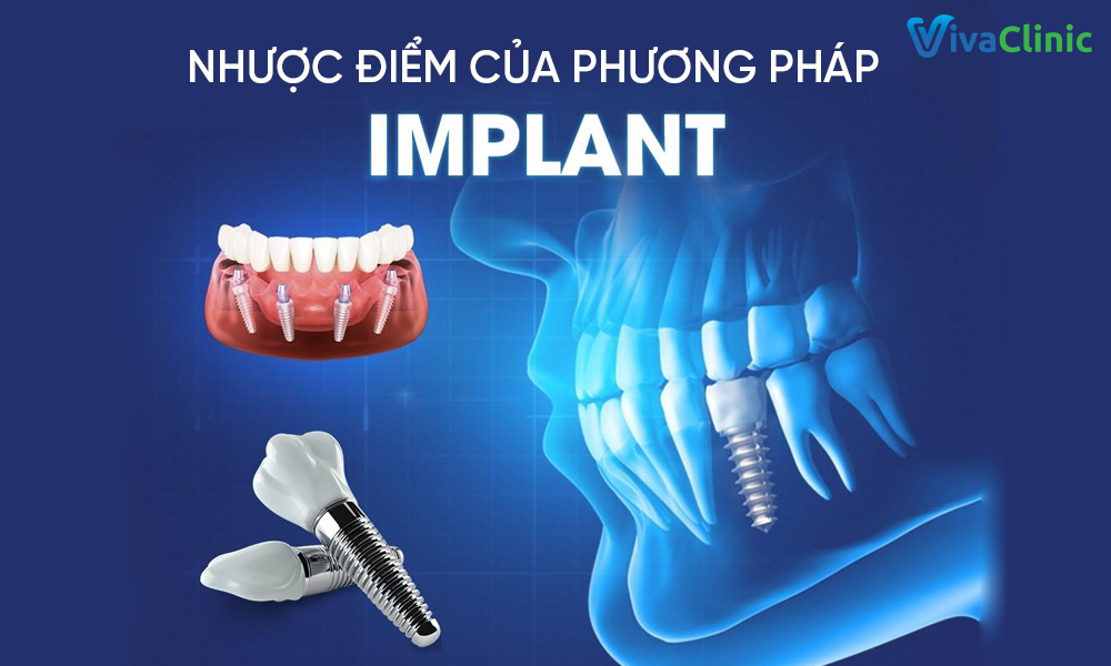 7 Nhược điểm của trồng răng implant mà bạn cần phải biết