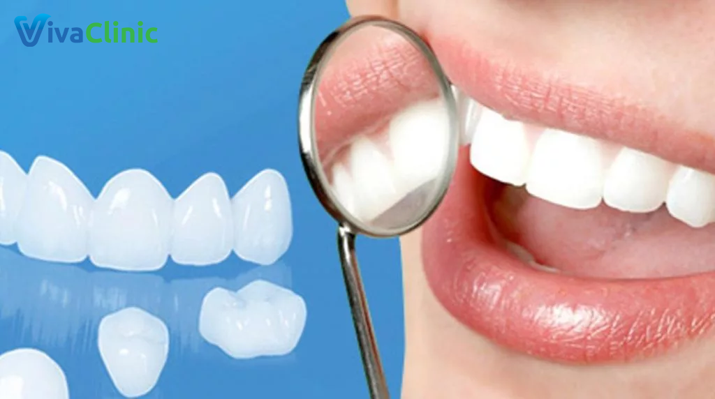 Răng sứ được gắn cố định lên răng thật nhưng vẫn có thể tháo ra được