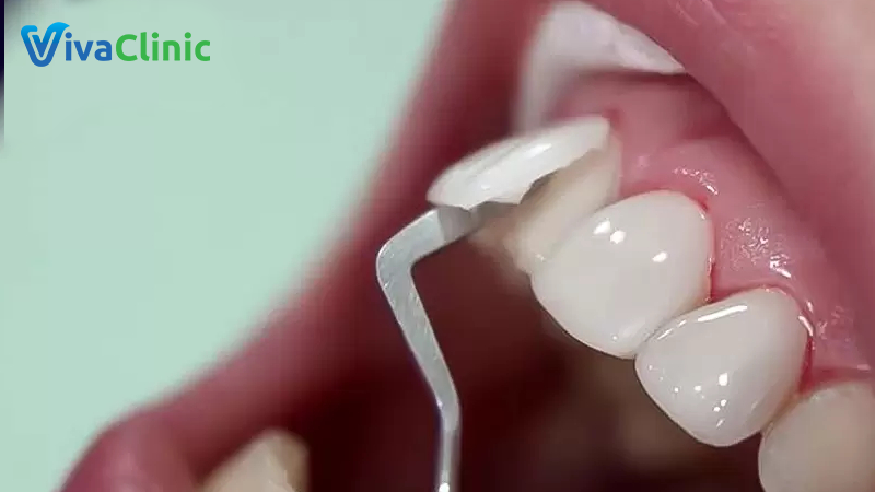 Những trường hợp nào nên thực hiện tháo và bọc lại răng sứ