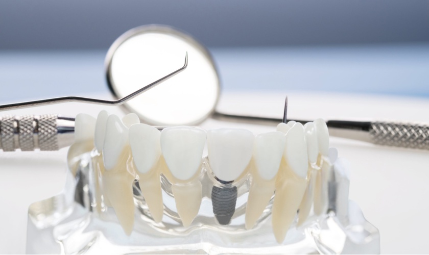 trồng răng implant hay còn được biết đến là cấy ghép implant