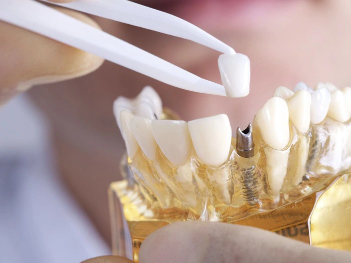 cấy ghép Implant đều được thực hiện nghiêm ngặt bởi đội ngũ bác sĩ giỏi, tỷ lệ thành công lên đến 99.9%.