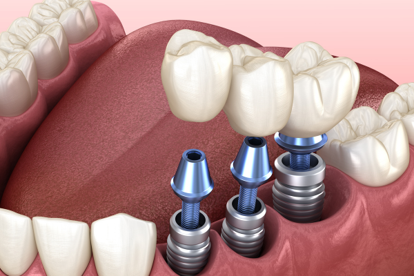 Trồng răng Implant có nguy hiểm không?
