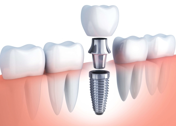 Tác hại của việc trồng răng implant gây ảnh đến hưởng sức khỏe