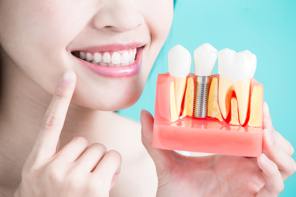 Tác hại của việc trồng răng implant mà bạn nên lưu ý