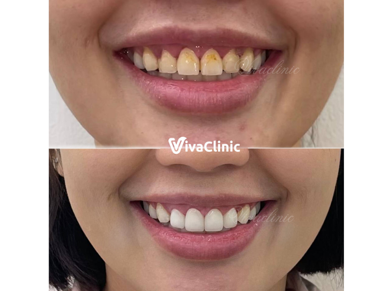 dan-su-veneer