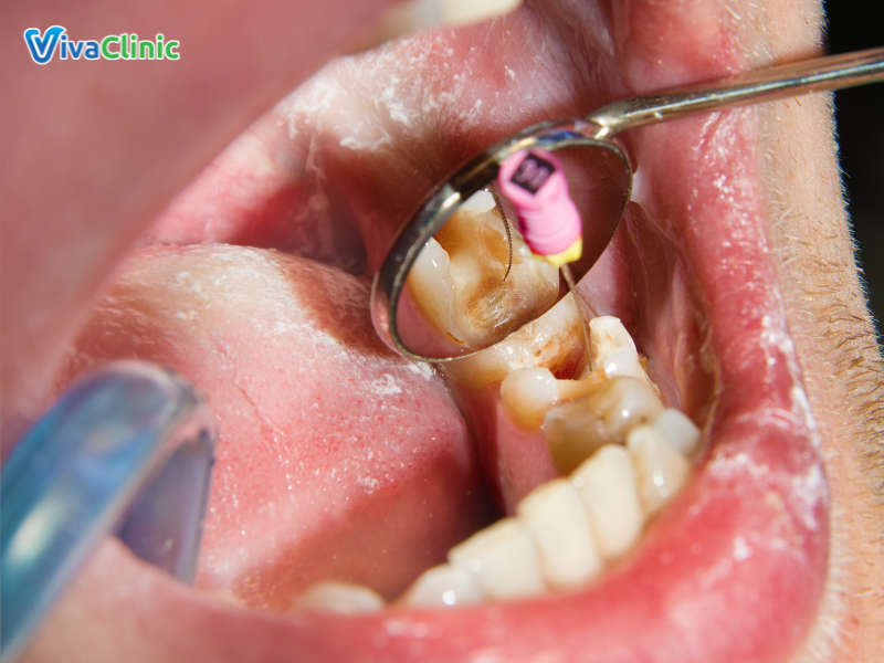 bọc răng sứ sau khi lấy tủy tại nha khoa Viva