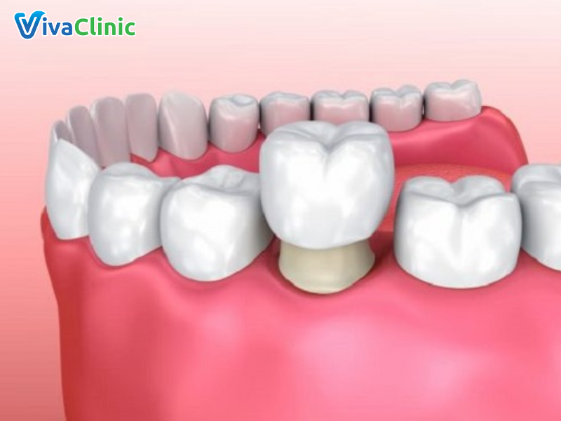Bọc răng sứ cho răng hàm là gì?