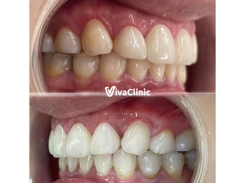 quy-trinh-dan-su-veneer