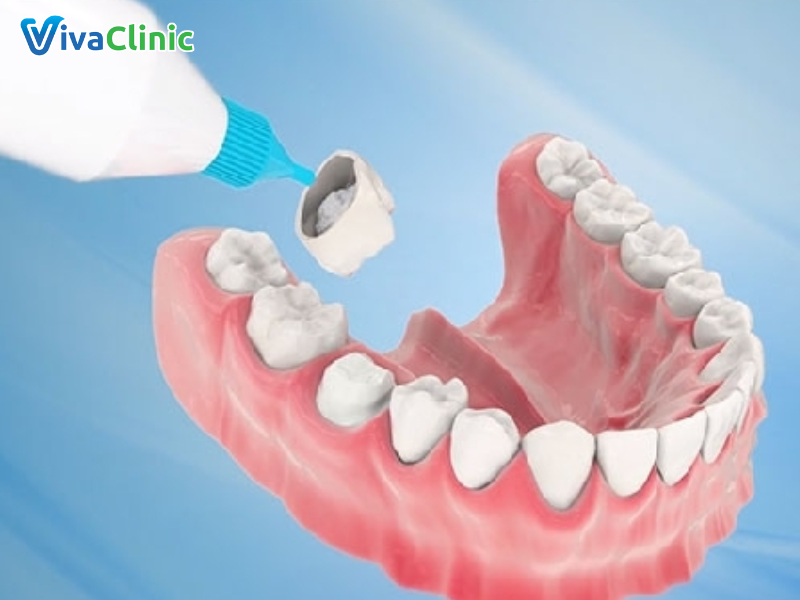 Bọc răng sứ răng hàm là cách bảo tồn răng thật tốt nhất
