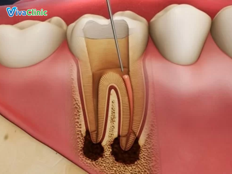 nên lựa chọn bọc răng sứ như thế nào sau khi lấy tủy