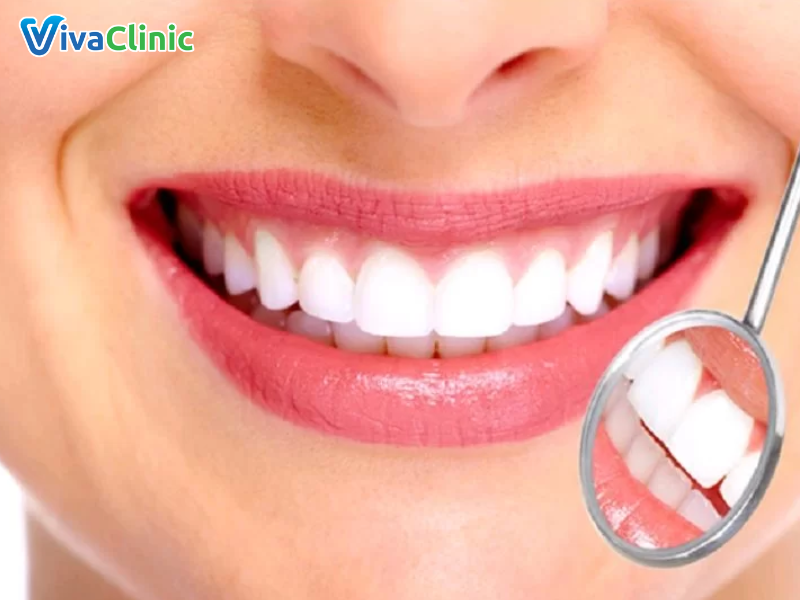 loại răng sứ nào đang được ưa chuộng để bọc răng sứ răng hàm