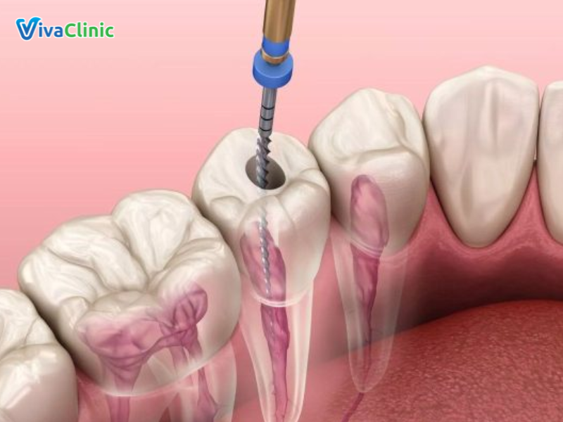 Lời khuyên dành cho người bọc răng sứ sau khi lấy tuỷ