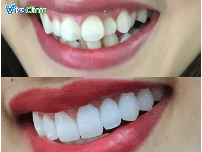 Lợi ích của việc bọc sứ răng hô