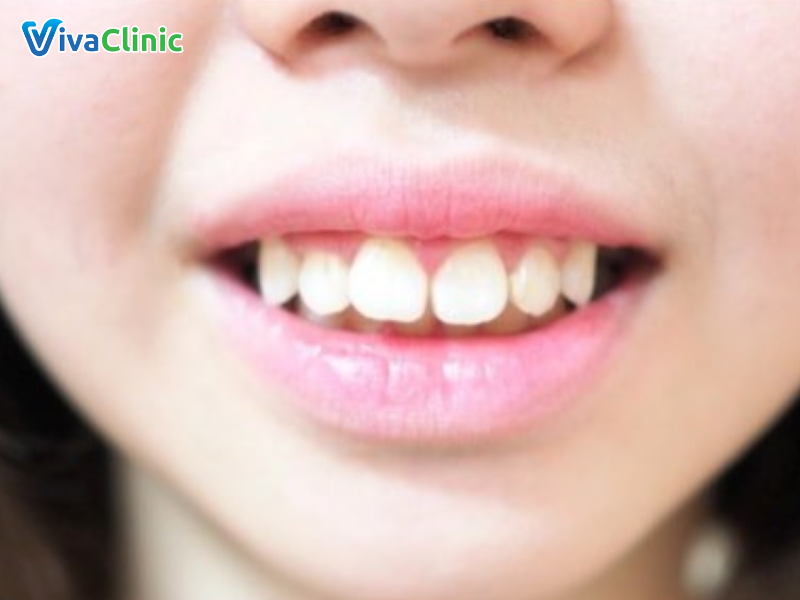 Bọc răng sứ có hết hô không?