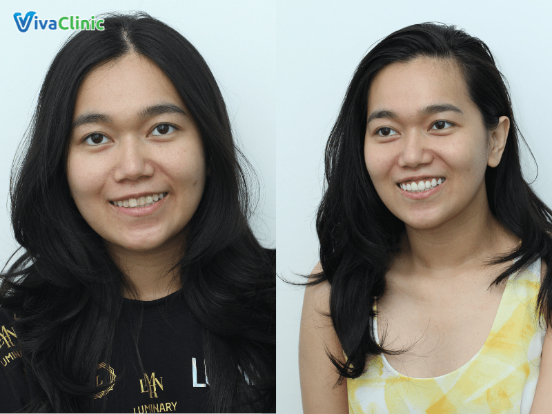 dan-su-veneer-tai-nha-khoa-via