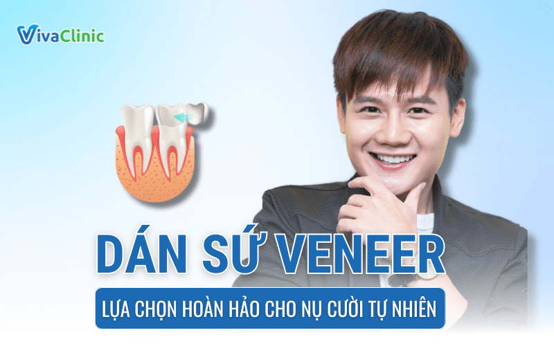 DAN SU VENEER LUA CHON HOAN HAO CHO NU CUOI TU NHIEN 1