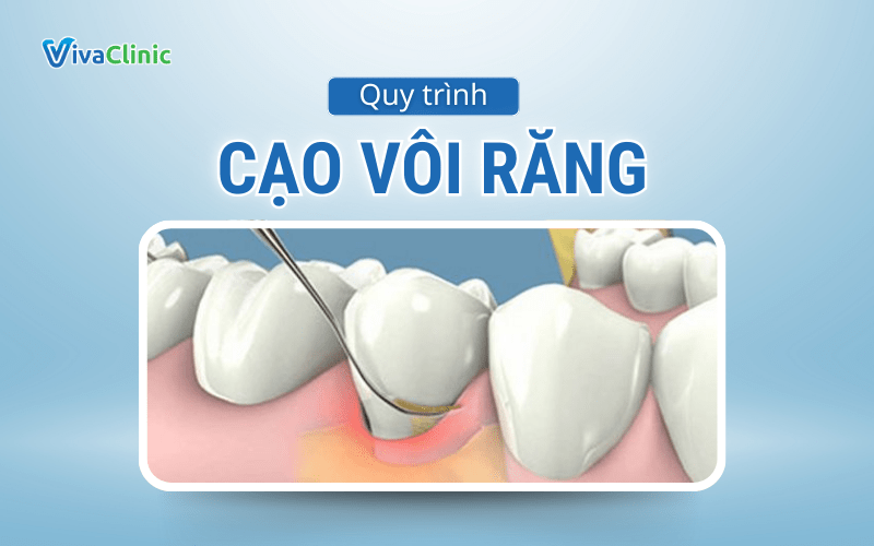QUY TRINH CAO VOI RANG TAI VIVA CLINIC 1