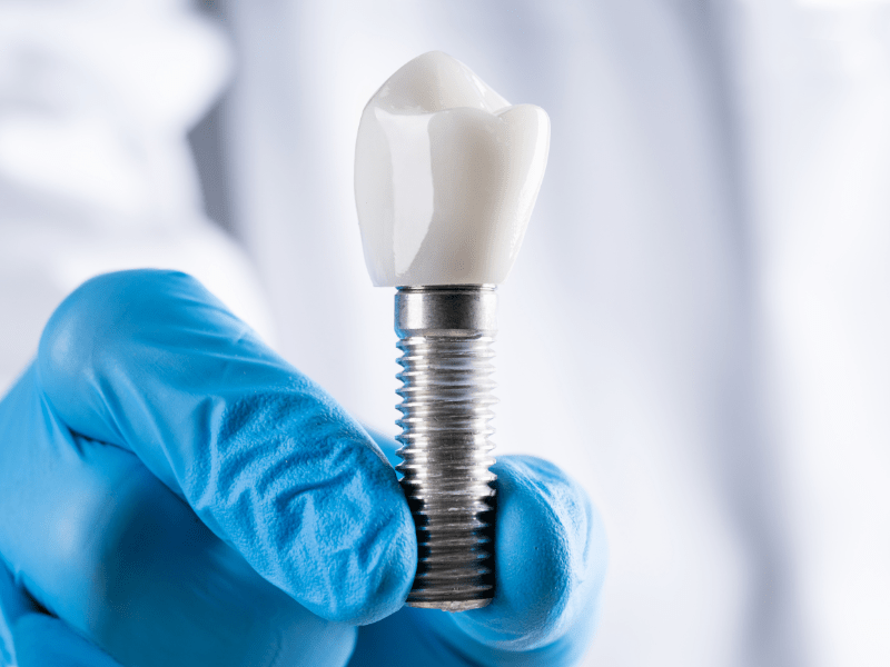 bao-ve-rang-implant