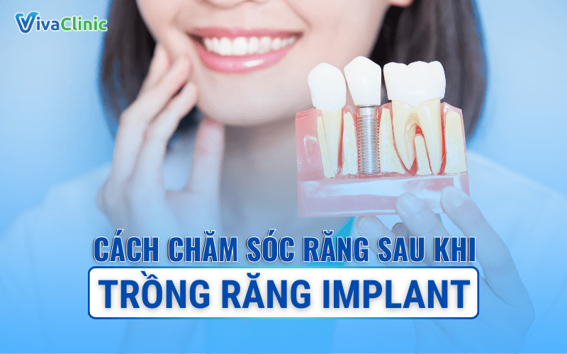CACH CHAM SOC RANG SAU KHI TRONG RANG IMPLANT 2