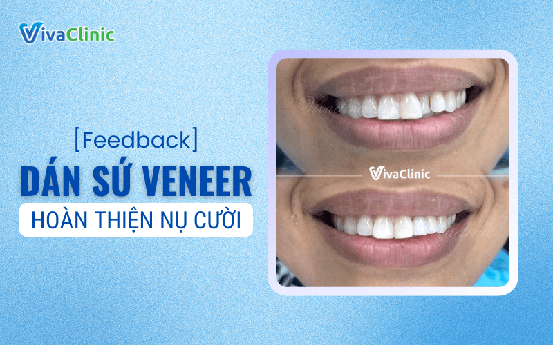 DAN SU VENEER HOAN THIEN NU CUOI TU TIN TOA SANG
