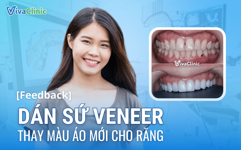 FEEDBACK DAN SU VENEER THAY MAU AO MOI CHO RANG