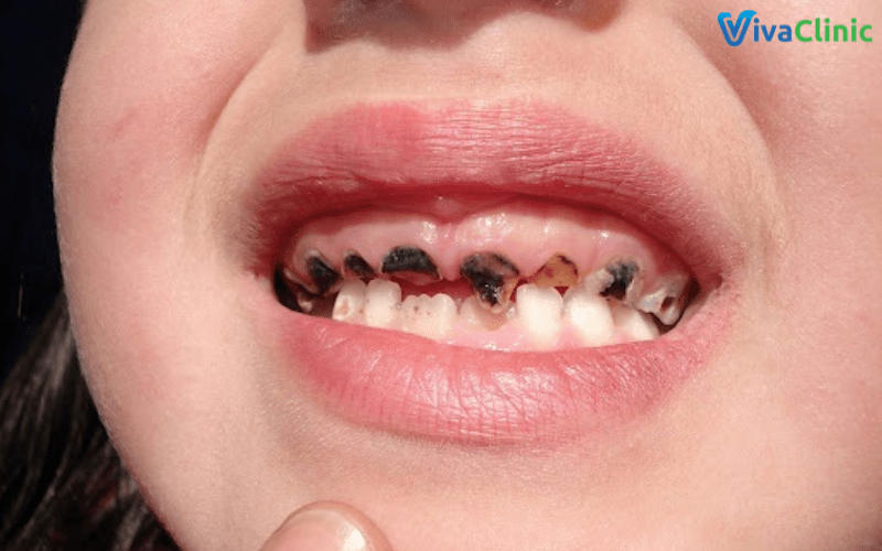 Sâu răng khi không được điều trị kịp thời có thể gây mất răng