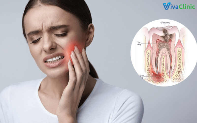 Răng sâu gây ra tình trạng đau nhức kéo dài